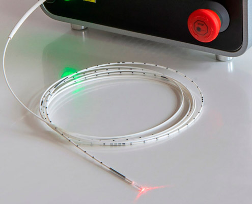 Laser-Katheder für endoluminale Venentherapie (Glasfaser-Sonde), hochwertige Radialfasern in zwei Durchmessern